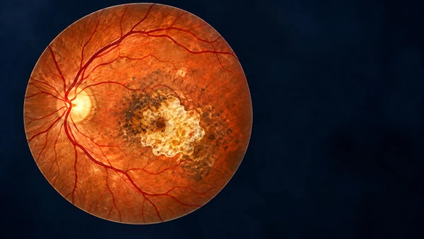 Sem cura, doença grave da retina ganha nova estratégia para retardar a perda da visão